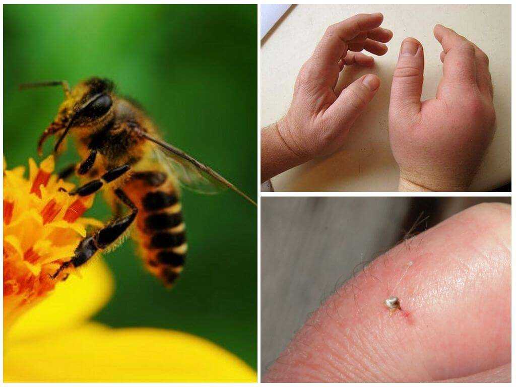 Кусаются ли шмели: особенности и описание насекомого, признаки и первая помощь при укусах