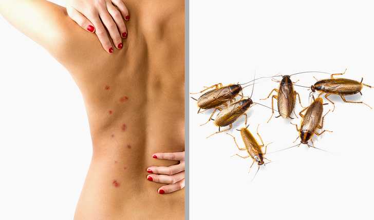 Может ли таракан укусить человека Как выглядит след от укуса таракана Чем опасен тараканий укус и чем обработать поврежденный участок кожи
