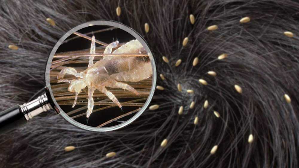 К чему снится что в волосах много насекомых