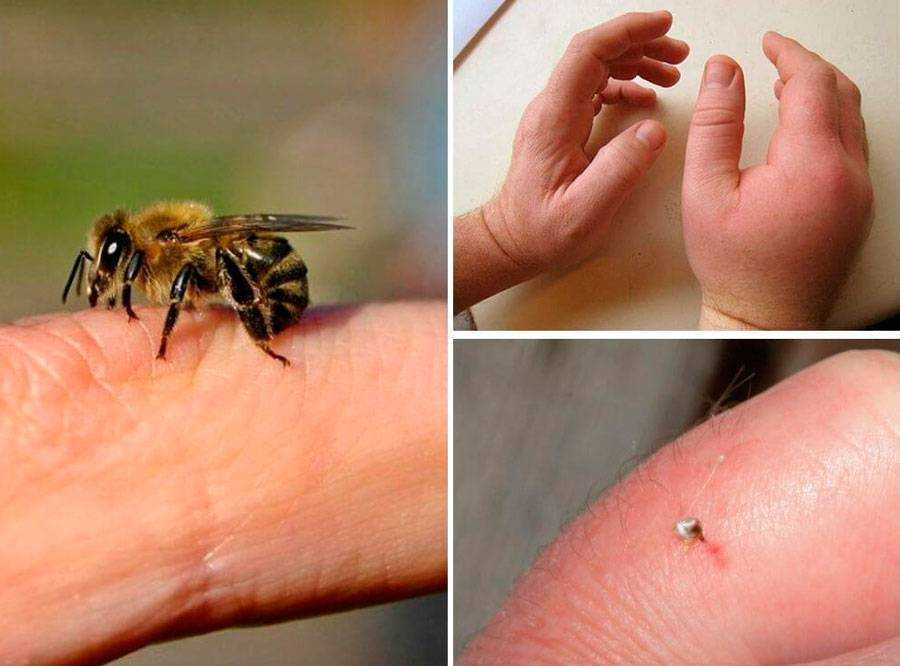 Ужалила пчела: лечение укусов и первая помощь пострадавшему
