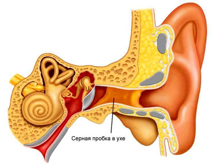 Серная пробка в ухе картинка