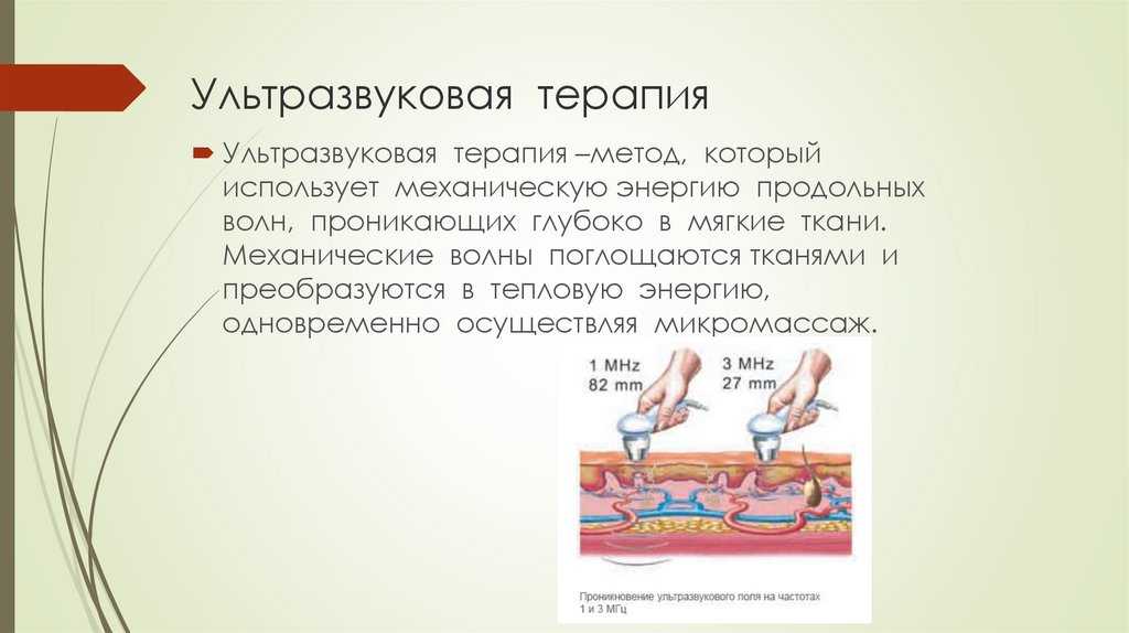 Схема ультразвуковая терапия