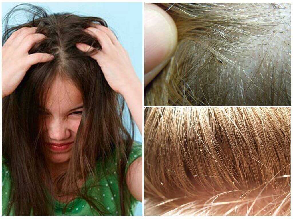 Перхоть и жирные волосы у девочки 10 лет что делать