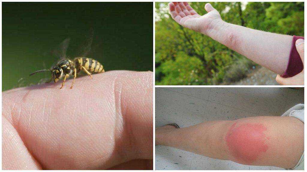 Аллергия на укус осы