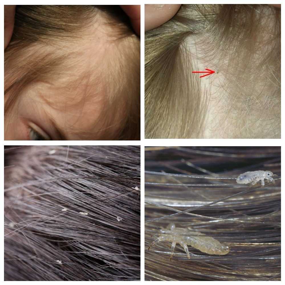 Как вывести блох у ребенка с длинными волосами