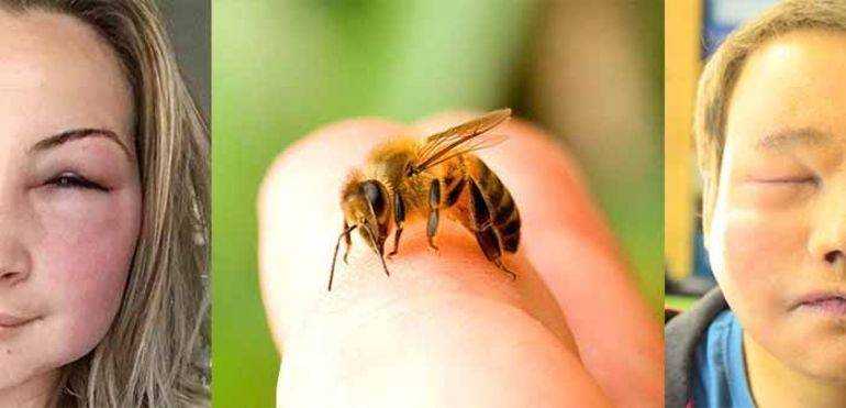 Беременную укусила пчела —что делать при укусе пчелы при беременности