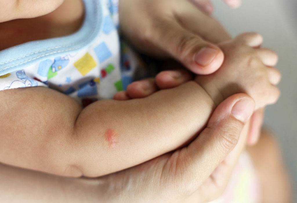 Рука нога когда у ребенка. Энтеровирусная экзантемема. Укусу комаров ух детей.