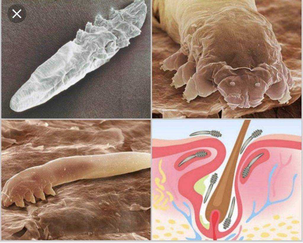 Угревая железница Demodex: внешний вид и переносимые заболевания Особенности угревой железницы Способы заражения подкожным клещом