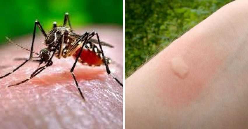 Укус малярийного комара: внешние признаки, симптомы, возможные последствия, первая помощь, мнение специалистов, фото